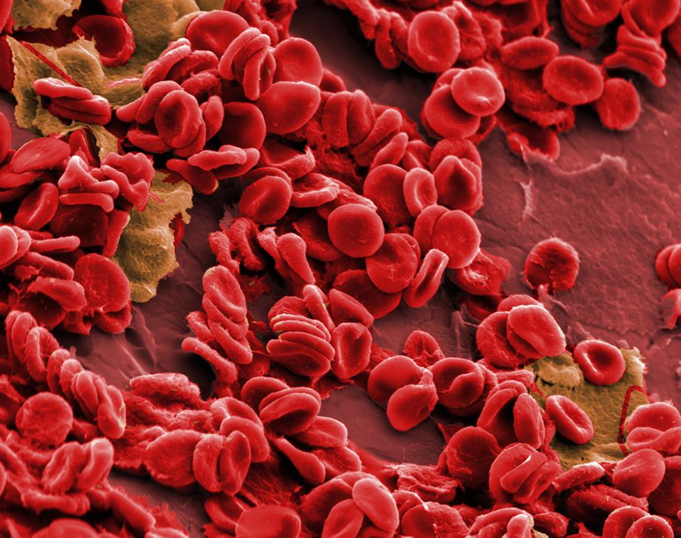 Blood cells on syringe needle